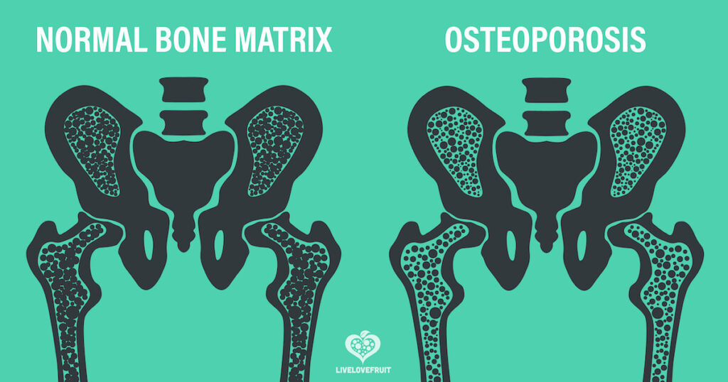 normali kaulų matrica, palyginti su osteoporoze sergančiais kaulais