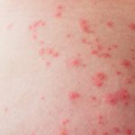 Raudonos dėmės ant odos: 14 priežasčių