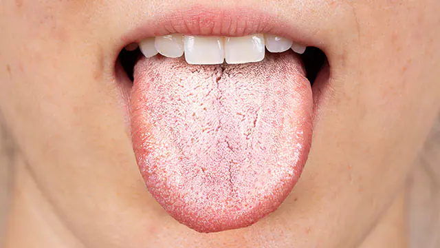 Baltas liežuvis: 6 priežastys ir kaip jo atsikratyti