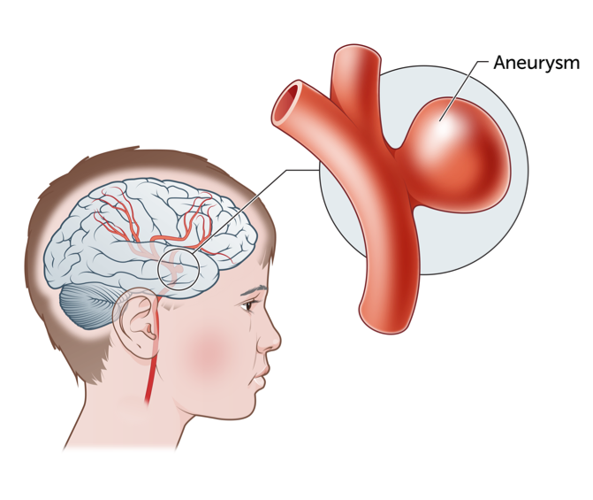 Aneurizmos simptomai: 5 smegenų ar širdies aneurizmos požymiai