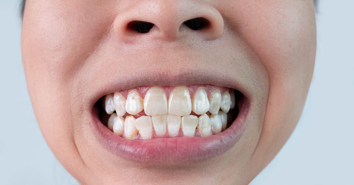 Baltos dėmės ant dantų – atsiradimo priežastys