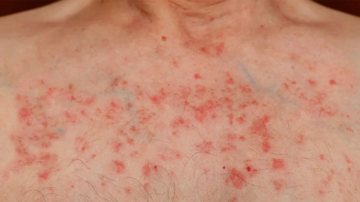 7 leukemijos požymiai