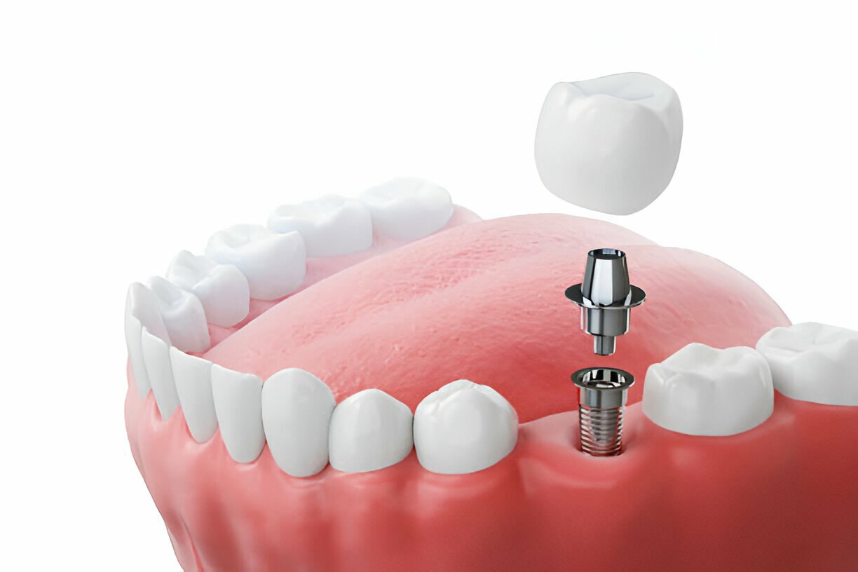 Dantų implantacija