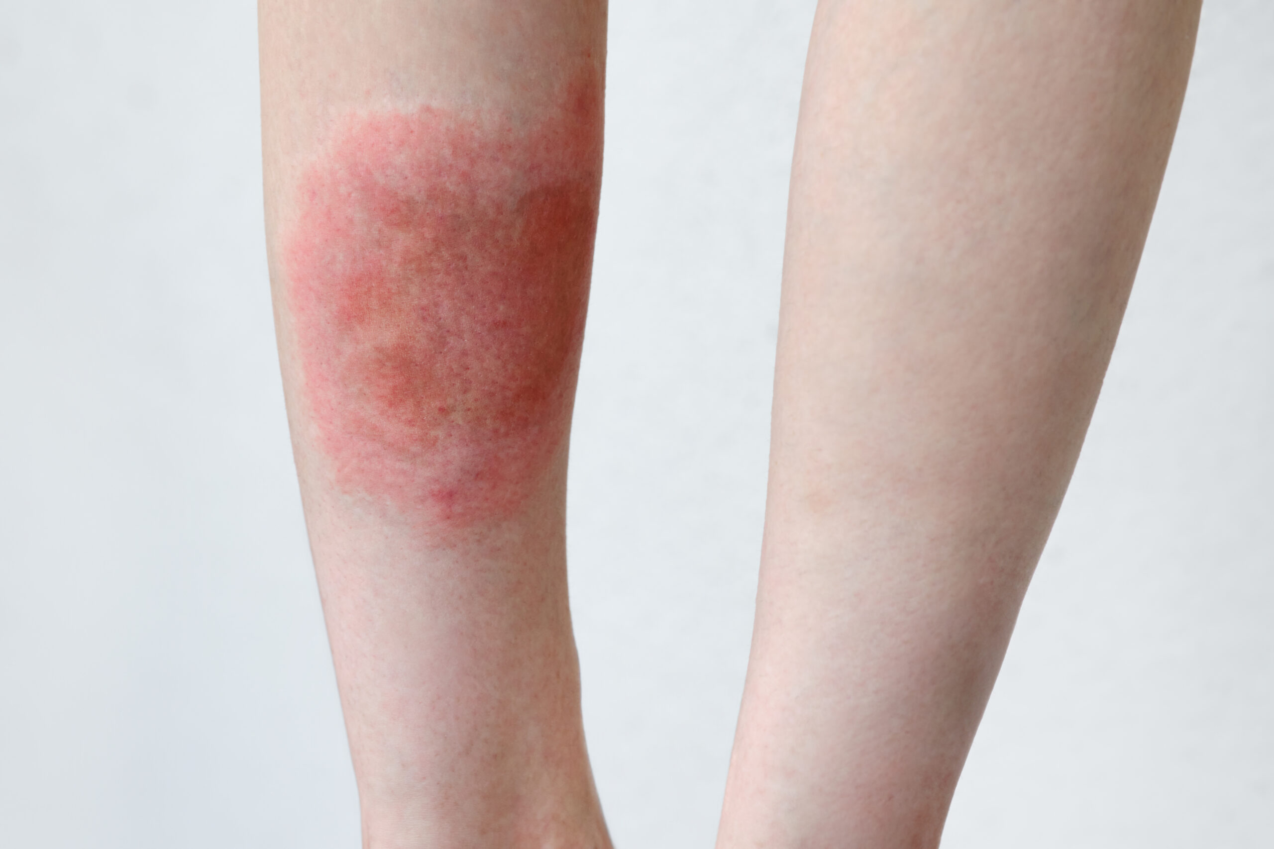 Ascia Rash Acetilcisteinas : vartojimas ir dozavimas