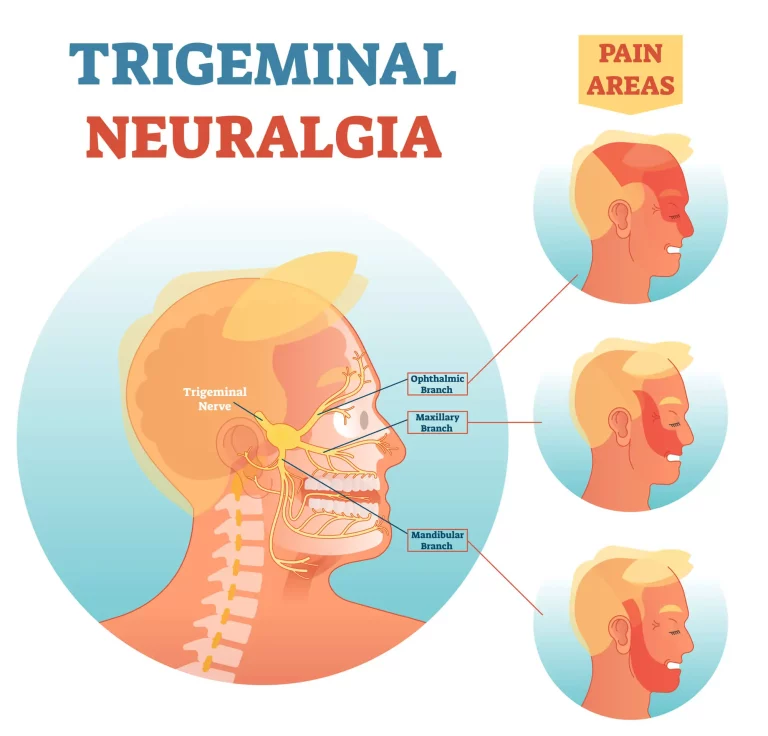 Trišakio nervo neuralgijos iliustracija